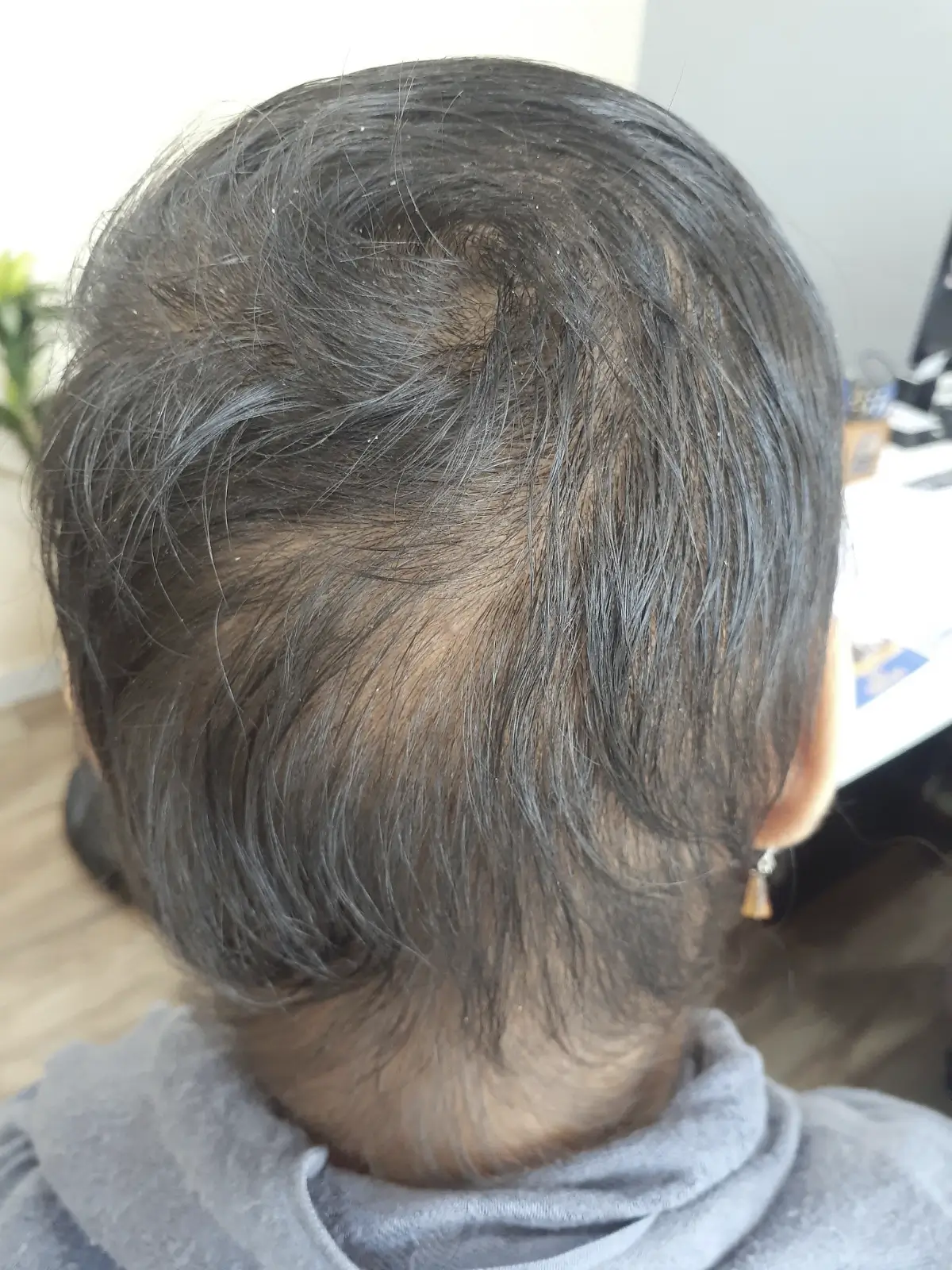 Alopecia Areata case 3 after treatment